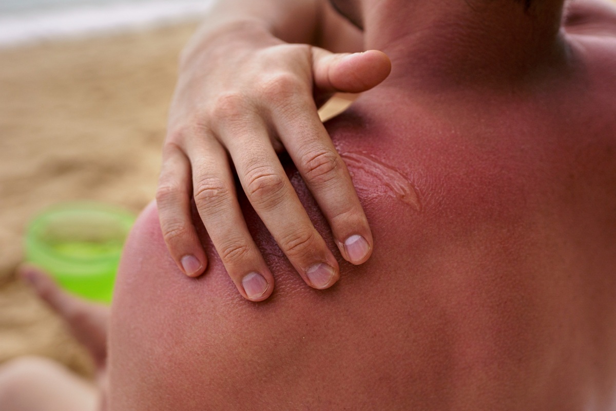 When to seek medical attention for sunburn