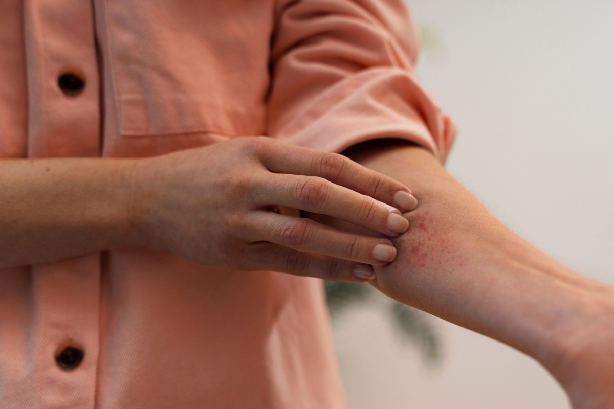 Close-up of a person in a peach shirt touching a red, irritated rash on their forearm, possibly indicating an allergic skin reaction.