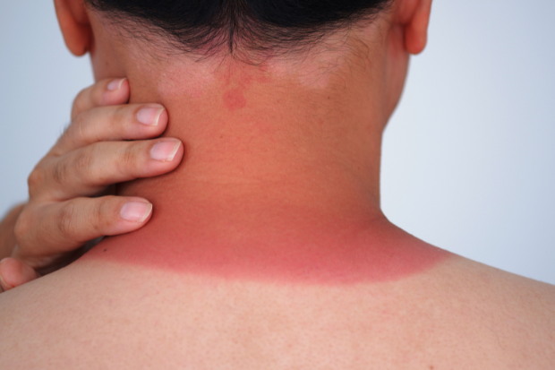 Sunburn Severity Chart: How to Identify and Treat Each Stage - Featured blog post image for LFA First Response