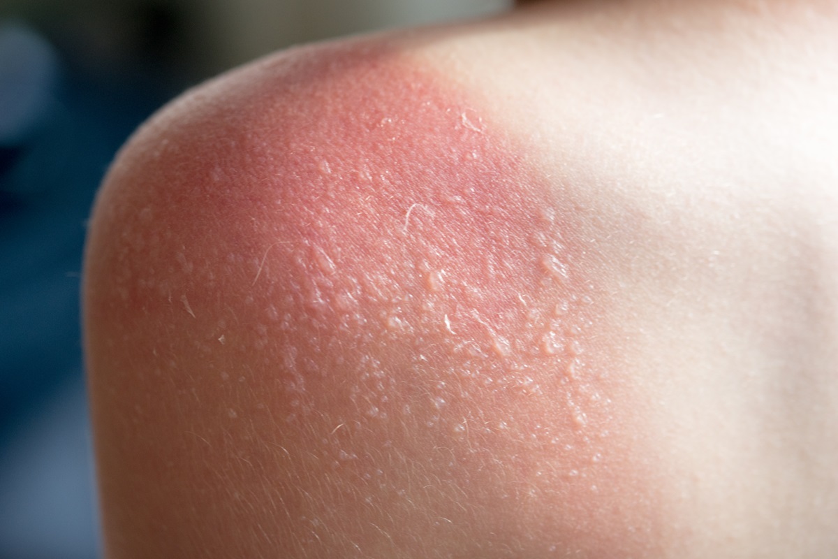 Sunburn 20 nov 2023