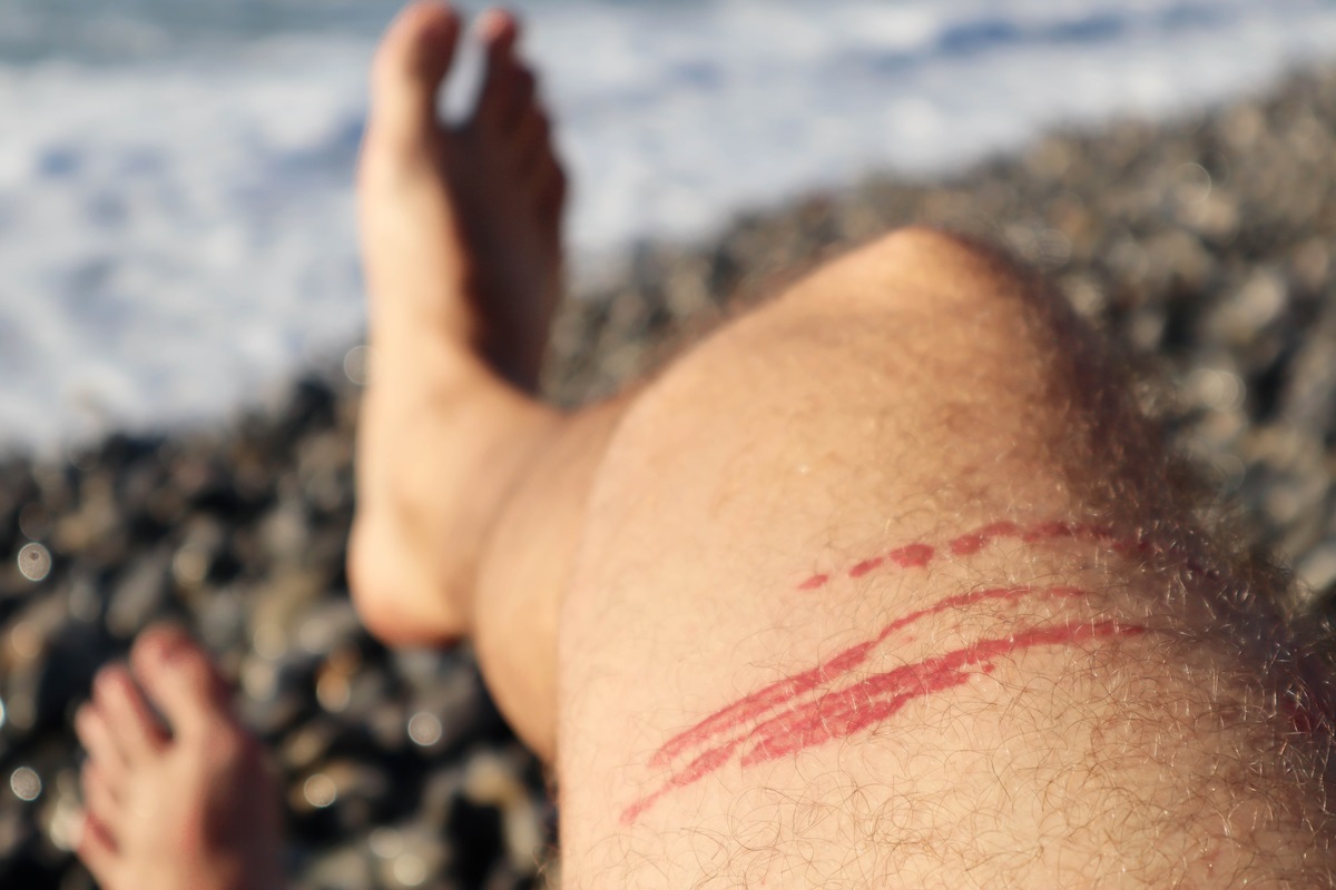 treating painful Stings